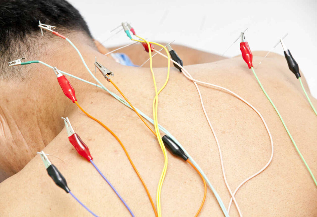 acupuncture for pinched nerve