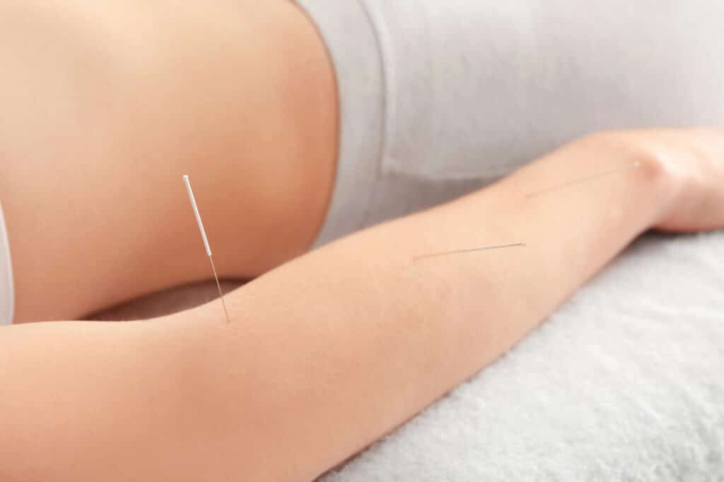 acupuncture for tennis elbow