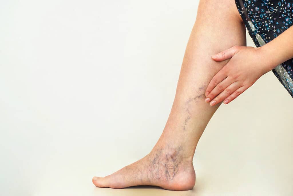 compression stockings for varicose veins