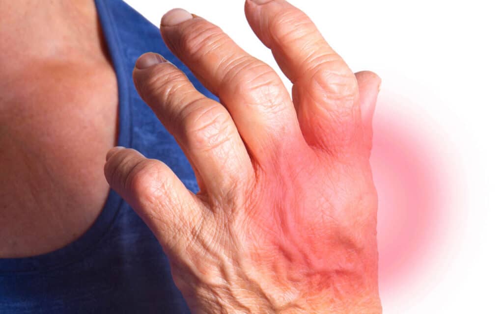 physiotherapy for rheumatoid arthritis